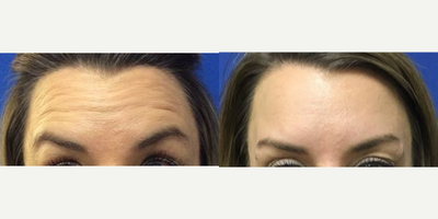 25-34 year old woman treated with Botox - Patient was treated with Botox for fine lines and wrinkles