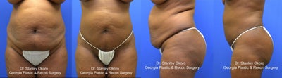 Mini Tummy Tuck - 
	Patient complained of abdominal excess fat and lower abdominal excess skin. Mini Tummy Tuck (Mini-Abdominoplasty) &amp; state-of-the art Five (5) step body sculpting process including micro cannula laser liposuction (SmartLipo) was performed. Procedure performed in the office procedure room using oral sedation without general anesthesia. IV sedation &amp; General anesthesia is available on request.
