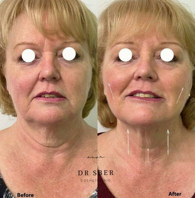 Woman treated with Silhouette Soft - Woman treated with Silhouette Soft