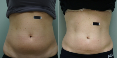 35-44 year old woman treated with Liposonix - Liposonix Before and AfterThe Liposonix fat reduction treatment is a non-surgical, non-invasive fat reduction treatment that uses high-intensity focused ultrasound energy (HIFU) to reduce fat cells.