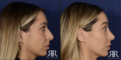 35-44 year old woman treated with Rhinoplasty - Rhinoplasty
