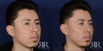 25-34 year old man treated with Chin Implant - chin augmentation