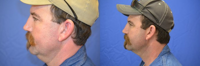 40 y/o male treated with SmartLipo Triplex to his neck - 40 y/o male who underwent SmartLipo Triplex to his neck under local anesthesia in the office.