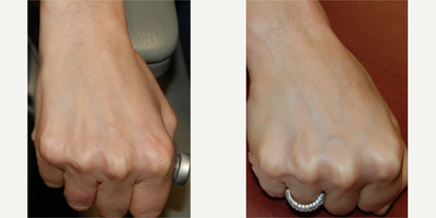 45-54 year old woman treated with Silikon 1000 to her hands for rejuvenation. - These photos demonstrate permanent hand rejuvenation using Silikon-1000, an off-label filler for permanent results. You can see more youthful appearing hands with fewer visible veins and tendons. This result was achieved after a single treatment.