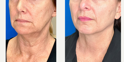 Woman treated with Endolift - Woman treated with Endolift.