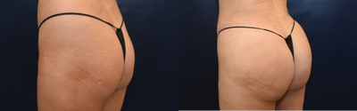 25-34 year old woman treated with Brazilian Butt Lift - This patient desired more volume to the buttocks to provide a more round appearance. 