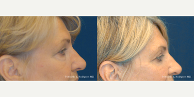 65-74 year old woman treated with Eyelid Surgery - 65-74 year old woman treated with Eyelid Surgery