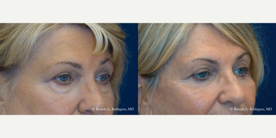 65-74 year old woman treated with Eyelid Surgery - 65-74 year old woman treated with Eyelid Surgery