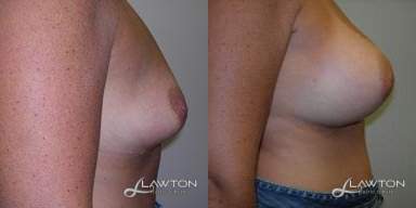 Breast Implant Revision - Age: 43 Height: 56 Weight (lbs): 165 Volume (cc): 600 Pre/Post: 38C/38D Follow Up (months): 3