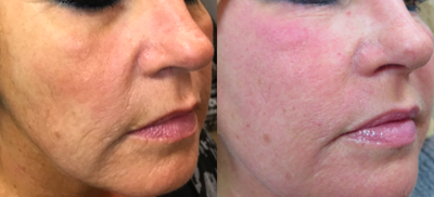 55-64 year old woman treated with J-Plasma Resurfacing - 3 weeks after aggressive J-Plasma resurfacing