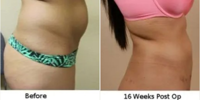 Woman treated with Liposuction - Woman treated with Liposuction