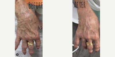 Woman treated with Skintyte - Check out these amazing results after just 2 Skintyte treatments.