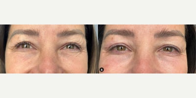 Woman treated with SkinCeuticals - Woman treated with SkinCeuticals