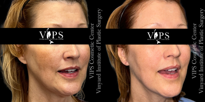 55-64 year old woman treated with Skin Lightening, Skin Rejuvenation, IPL - 55-64 year old patient treated with a series of (3) Elluminate Advanced Photofacial with IPL treatments for hyperpigmentation on the face, age spots and sun damage. The result is more even skin tone, a reduction in visible hyperpigmentation and and overall brightness to her skin's appearance