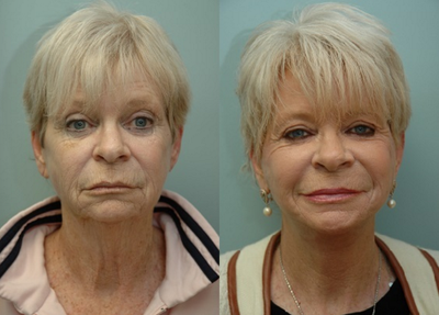Wise Revitalize Lift - Wise Revitalize Lift