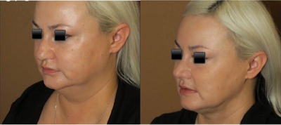 Woman treated with Liposuction - Liposuction to the neck and jaw area