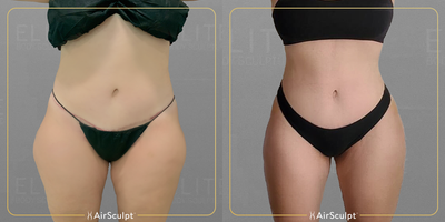 25-34 year old woman treated with AirSculpt - Heres what subject looks like just seven days after treating her waist and outer thighs.Although she has already achieved the coveted hourglass figure, her newly sculpted contours will only become more accentuated in the coming month thanks to the innovative design of AirSculpt technology.