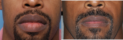 35 Year Old Male Treated for Large Lips - It took two lip reduction operations to achieve a significant reduction in upper and lower lip size.