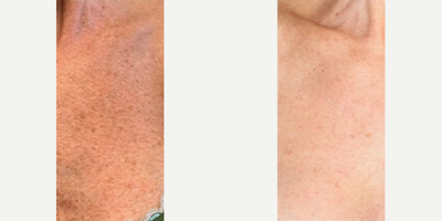 Woman treated with Moxi - MOXI & BBL laser treatments lighten and brighten skin affected by sun damage/brown spots. Even one treatment revitalizes skin, leaving it glowing!