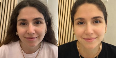 25-34 year old woman treated with PRF Treatment - This 31 year old female patient wanted to refresh tired-looking under-eyes and soften mild hollowing. She completed 3 PRF under-eye sessions using her own natural growth factors to stimulate collagen and improve skin quality. After treatment, her under-eye area appears brighter, smoother, and more rested with subtle, natural-looking improvement. Results continue to enhance over time as collagen rebuilds.