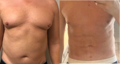 Man treated with Body-Jet - Man treated with Body-Jet (2 treatments of body contouring). He underwentliposuction on his breast tissue fora firmer, more shapely appearance and abs etching togive the abdominal muscles a more sculpted, toned appearance.