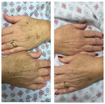 55-64 year old woman treated with GentleLase - 2 treatments.