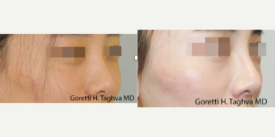 18-24 year old woman treated with Asian Rhinoplasty - Asian Rhinoplasty with ePTFE implant