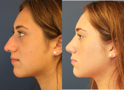 17 or under year old woman treated with Rhinoplasty - 17 or under year old woman treated with openRhinoplasty