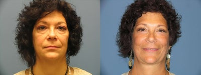 Quicklift w/neck liposuction, Upper and Lower Eyelids, Mixto Laser Resurfacing - 
	Pt is 6 months post Quicklift w/neck liposuction, Upper and Lid Blepharoplasty, Mixto Laser Resurfacing
