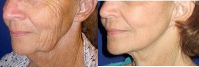 Facelift,  Necklift,  Fractional CO2 Laser Skin Resurfacing - This patient had a facelift, neck lift, and full face CO2 laser skin resurfacing under local anesthesia (no general anesthesia). Her advanced signs of aging require a meticulous technique to ensure a natural look.