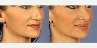 25-34 year old woman treated with Juvederm - Lip Augmentation with Juvederm.