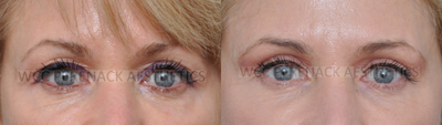 55-64 year old woman treated with Eyelid Surgery - Eyelid surgery or blepharoplasty can correct sagging eyelids, remove fatty pouches beneath the eyes and remove excess skin from the upper eyelids. Blepharoplasty can be done alone or with other facial procedures. This patient had an Upper Blepharoplasty only.