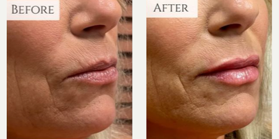 Woman treated with Lip Fillers, Dermal Fillers, Lip Lift - This beautiful look was achieved using just 1ml of Volbella filler in the lips and we are in love with the results!