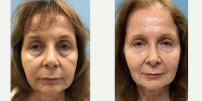 Woman treated with Botox, Dermal Fillers - Take a moment to admire this stunning patient's remarkable journey from her before and after photos with Dr. Wolf.Here is the twist!This patients transformation isnt the result of surgery. Instead, she has been receiving injectable treatments of Botox and Fillers by Dr. Wolf throughout the years This before and after photo is taken 6 years apart and you can see the incredible impact that can be achieved with time, patience, and a skilled facial plastic surgeon by your side. Through the magic of precision individualized Botox and filler injections, Dr. Wolf has helped her achieve a look that defies time! Her rejuvenated appearance is a testament to the artistry of non-surgical enhancements.