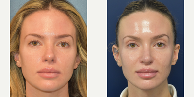 25-34 year old woman treated with Septoplasty, Rhinoplasty, Revision Rhinoplasty - A woman in her 30s, who had a previous rhinoplasty which left her with an over-projecting elongated nasal tip, over-rotated tip, dorsal hump, severe tip asymmetry, nostril asymmetry, and indented/collapsed dorsal aesthetic lines.  She is now 8 months post-op from revision rhinoplasty with tip de-rotation, nasal tip deprojection to shorten the overall length of her nose, improvement of tip symmetry, dorsal hump reduction, correction of dorsal aesthetic line collapse, and placement of a columellar strut graft and spreader grafts using MTF cartilage to add tip support, tip refinement, and improve her breathing.