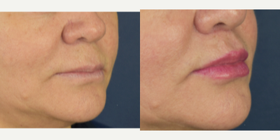 45-54 year old woman treated with Lip Lift, Lip Surgery, Lip Repositioning, Lip Fillers - Female patient who want more shape and volumen on her lips, she was concern about her upper lip looks to long. I performed a bullhorn lip lift, and fat transfer to the upper and lower lip. Now she has more youthful appearances , more volumen, definition and lipo projection.