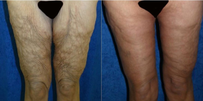 55-64 year old woman treated with Thigh Lift - This is a 56 year-old female who weighed 315lbs. at her heaviest. Dr. Katzen also performed a bilateral medial vertical thigh lift. During the thigh lift, thigh liposuction was performed. Then, an incision was made from the groin to the inner knee on the inside of the thigh. Two large elliptical areas of skin and fat were removed from the inner thighs and the thighs were tightened.