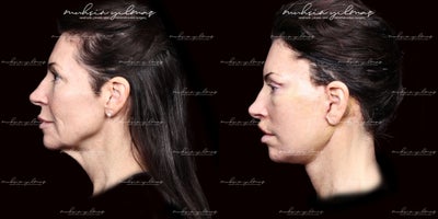 45-54 year old woman treated with Deep Plane Facelift, Neck Lift, Lip Lift, Eyelid Surgery, Brow Lift - This 45-54-year-old patient underwent a combination of Deep Plane Facelift, Neck Lift, Chin Implant, and Buccal Fat Removal to achieve a harmonious and rejuvenated facial appearance. The Deep Plane Facelift lifted and redefined the deeper facial tissues, restoring youthful contours. The Neck Lift addressed sagging skin and created a smoother neck profile, while the Chin Implant enhanced chin projection for a more balanced facial structure. Buccal Fat Removal further refined her mid-face by reducing fullness, resulting in a slimmer and more sculpted look. At 6 months post-operative, the patients results highlight the natural-looking and transformative outcomes achieved through these combined procedures, enhancing her confidence and overall appearance.