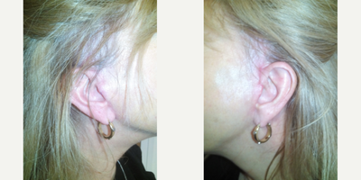 NONCOMP 55-64 year old woman treated with Facelift - These picture illustrate how well the incisions I use for my facelift heal and how well they are hidden. I never cut in front of the ear but run the incision behind the patient's tragus.
