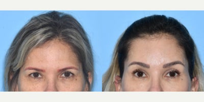 Woman treated with Brow Lift - Woman treated with Brow Lift to address brow ptosis and Eyelid Surgery through upper blepharoplasty to address the hooding.