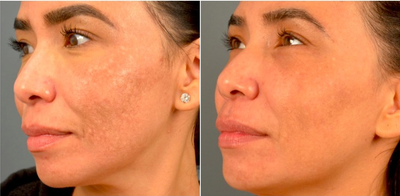 35-44 year old woman treated with Fractional Laser - fractional laser/RF for the treatment of melasma/post inflammatory hyperpigmentation.