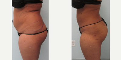 Gruber Booty - Lipo Only! No Implants, No Injections, No Fat Transfer - AWAKE liposuction, tiny pinpoint scars, minimal 3 day downtime, easy recovery. Dr. Gruber sculpts your body in a natural way to create a rounder, lifted appearance to the buttocks with the least amount risk possible.