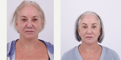 65-74 year old woman treated with Facelift, Neck Lift, Facial Fat Transfer, CO2 Laser - 68 year old patient 7months post-facelift, necklift, fat transfer, CO2 laser.