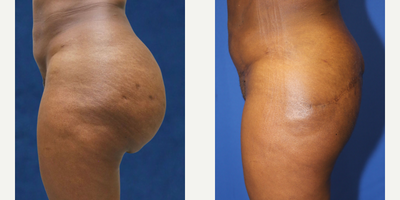 45-54 year old woman treated with Silicone Injection Removal - Meet our brave patient, a 52-year-old black female who stands at 5'4 and weighs 157 pounds. In 2008, she had raw silicone injected into her buttocks, which resulted in high blood pressure, brain fog, and anxiety. The adverse effects of the silicone injection led her to seek medical help to have it removed.In August 2021, she traveled all the way from New Jersey to California to see Dr. J. Timothy Katzen, a renowned surgeon, for the silicone removal procedure. The patient also underwent a posterior body lift to reconstruct her buttocks.After the surgery, the patient expressed her satisfaction with the remarkable outcome of the procedure. She is relieved to be free from the adverse effects caused by the silicone injection. We commend her bravery and determination in seeking medical assistance to restore her health and well-being.