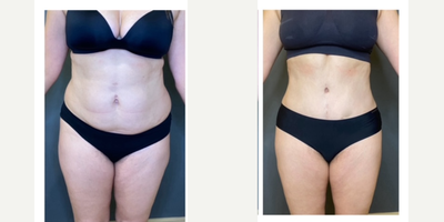 35-44 year old woman treated with Tummy Tuck, Liposuction, Liposculpture, Tumescent Liposuction, Diastasis Recti Repair - 44 year old mom who is shown before and 13 months after full tummy tuck with rectus diastasis muscle repair and liposuction of the flanks and lateral thighs. Her pants and dress size decreased  by 2-3 sizes!Ht. - 56. Wt- 174lbs  before and 160lbs after!