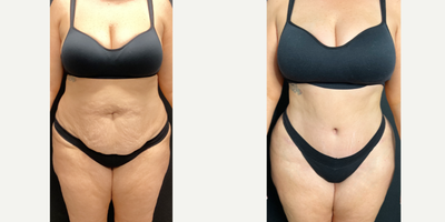 25-34 year old woman treated with Liposuction, Diastasis Recti Repair - The patient received a tummy tuck with diastasis recti repair.