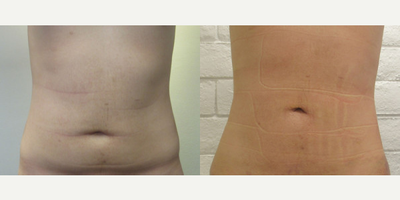 Woman treated with BodyTite - BodyTite
