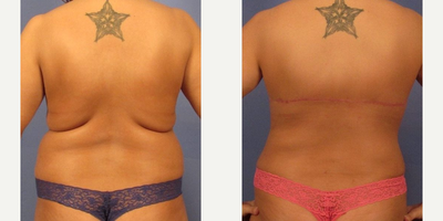 35-44 year old woman treated with Mommy Makeover - Mommy Makeover - Tummy tuck, breast augmentation, and posterior bra line lift. This woman in her late 30s underwent a fully mommy makeover performed by Dr. Bryson Richards. She also underwent a posterior bra line lift. She had 600cc high profile implants placed in a submuscular position through an inframammary fold incision.