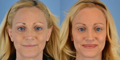 45-54 year old woman treated with ArteFill - 46 year old female received ArteFill to cheeks, temples, and under eyes