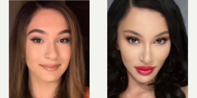 Woman treated with Facial Feminization Surgery - Woman treated with Facial Feminization Surgery